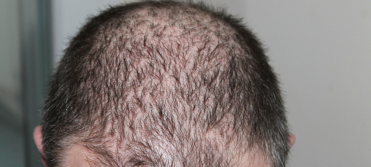 Male Hair Loss