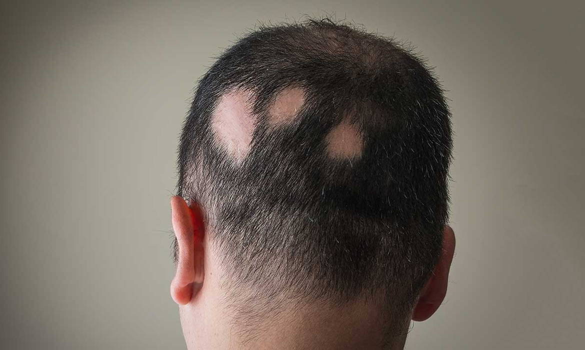 alopecia areata